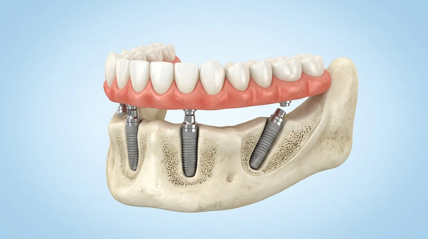 All-on-4 dental implant model showing four implants supporting a full arch prosthesis