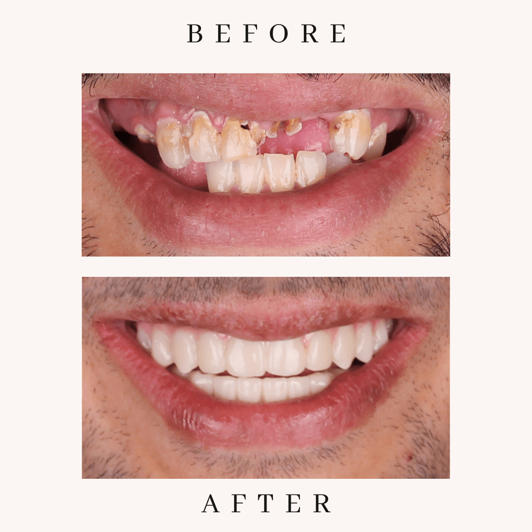 Full mouth reconstruction consultation at Meadowbrook Dental