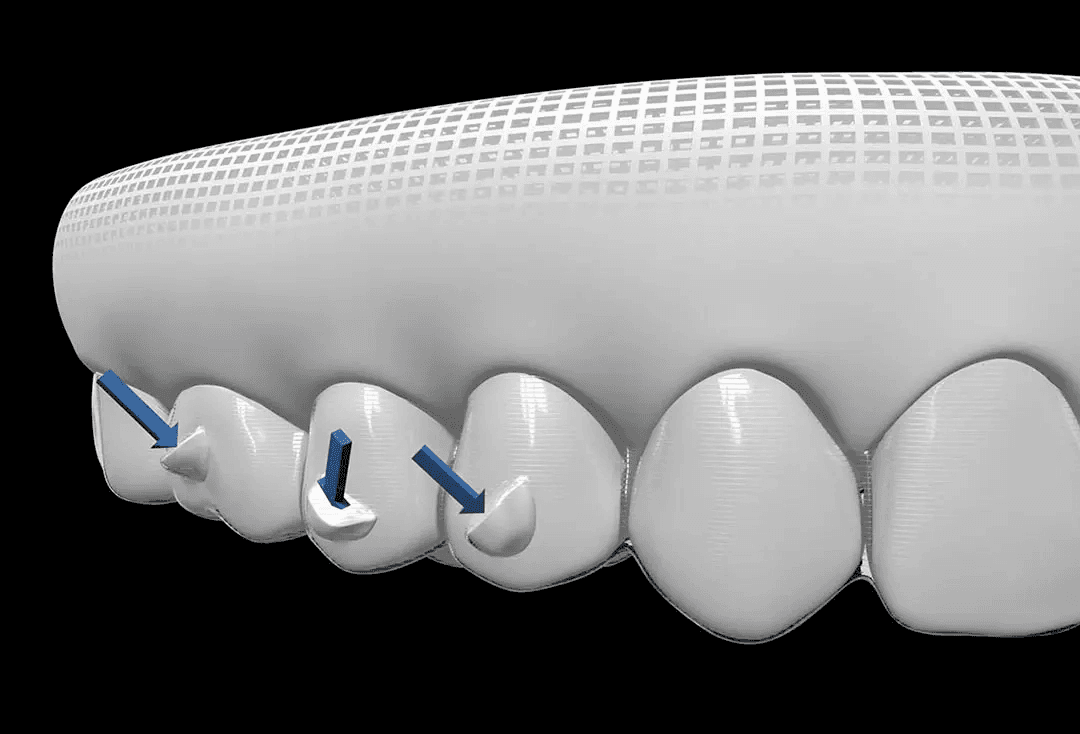 Digital Invisalign treatment plan on screen