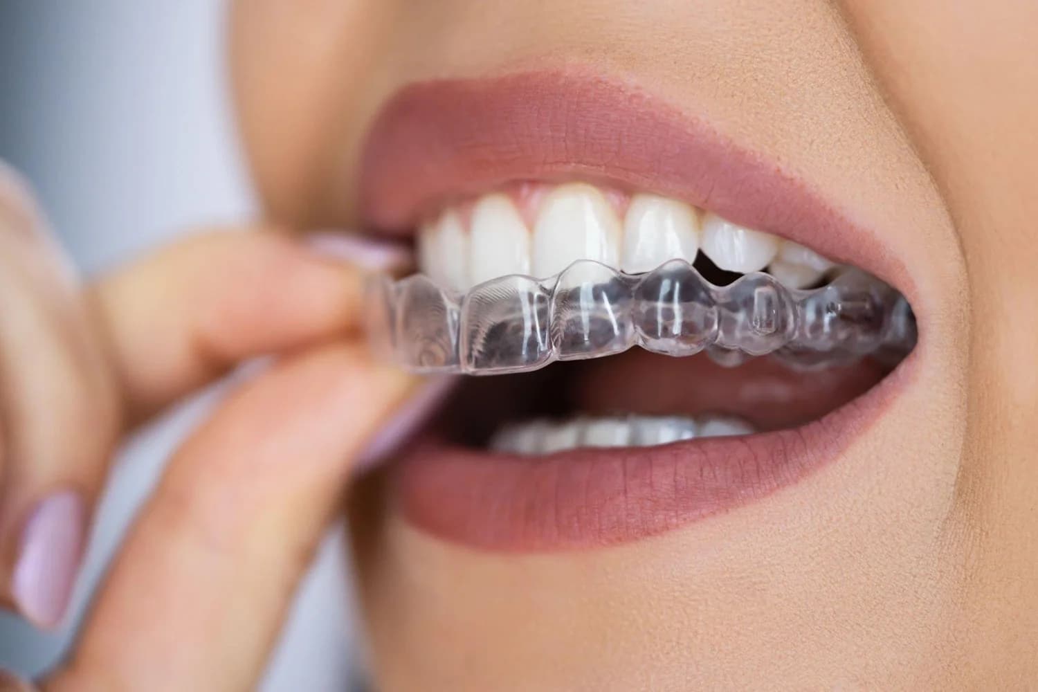 Patient holding Invisalign clear aligners