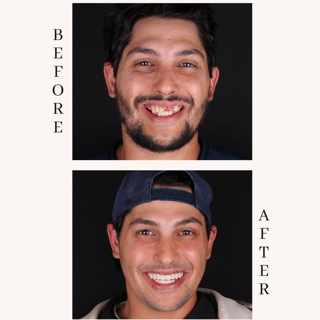 All-on-4 dental implant transformation at Meadowbrook Dental