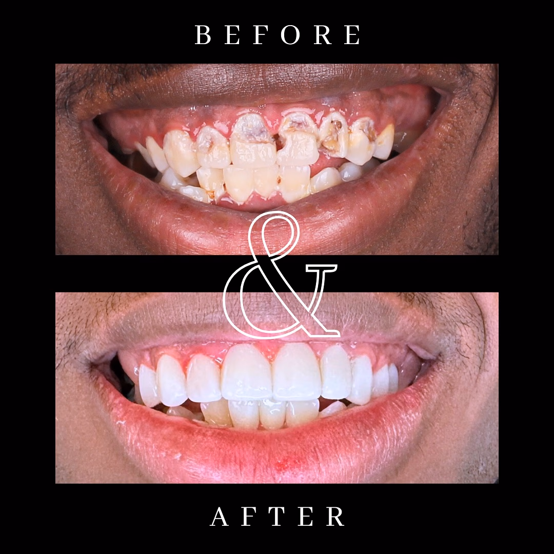 Before and after smile transformation 1
