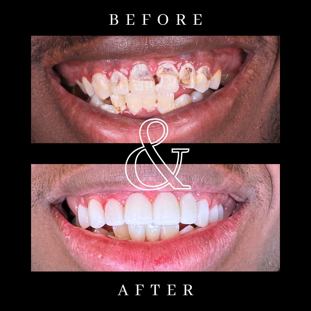 Before and after smile transformation 1