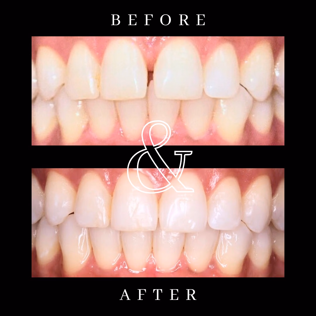 Before and after smile transformation 3
