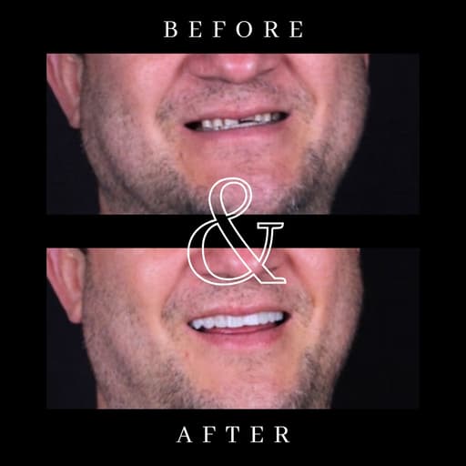 Before and after smile transformation 4